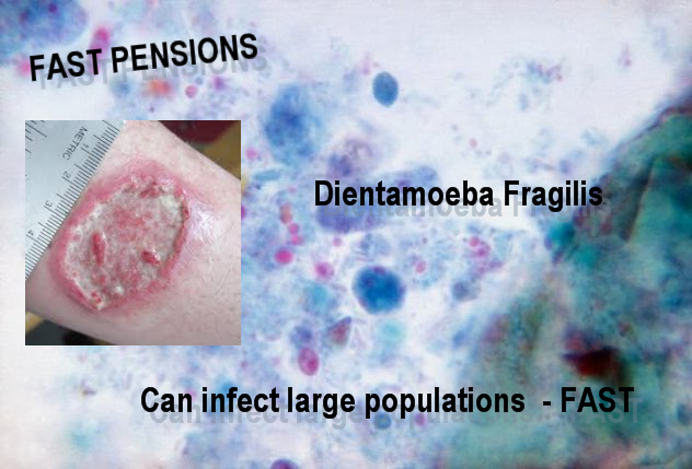 Pension Life blog - Fast Pensions compared to Dientamoeba Fragilis in top 10 deadliest pension scams they were number 3
